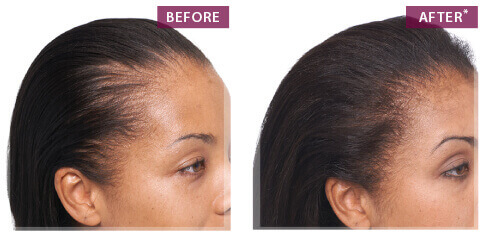 Keranique Hair Regrowth | Hair Growth Products For Women