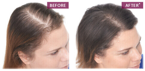 Keranique Hair Regrowth | Hair Growth Products For Women